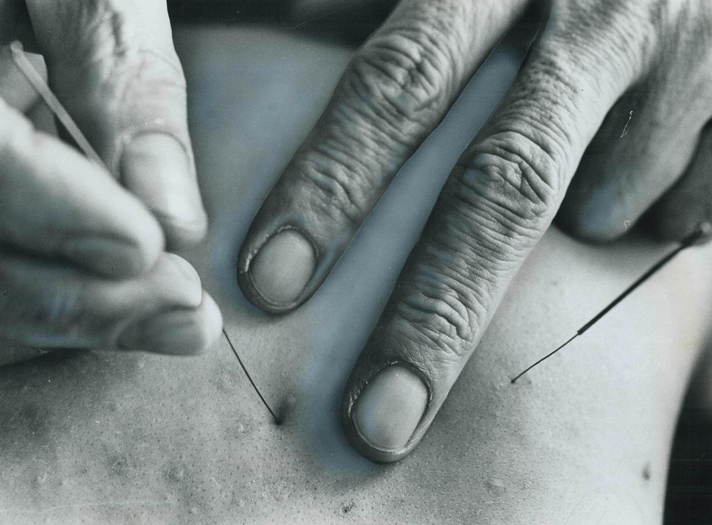 A close-up of a needle being inserted in patient, Acupuncture needles are as fine as a human hair