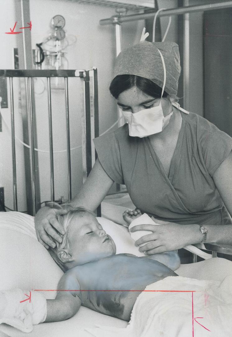 Badly burned when his pyjamas caught fire, apparently while he was playing with matches, 2-year-old George Bell is checked by nurse Joan Swarbrick in (...)