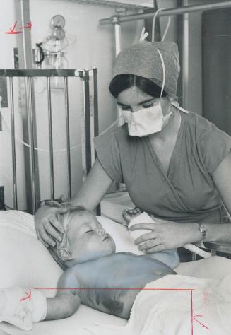 Badly burned when his pyjamas caught fire, apparently while he was playing with matches, 2-year-old George Bell is checked by nurse Joan Swarbrick in (...)
