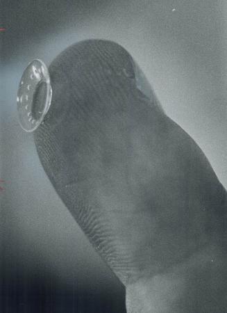 Tiny plastic cornea, the size of a button, used in yesterday's transplant operation is shown balanced on end of a finger to illustrate its size. It is(...)