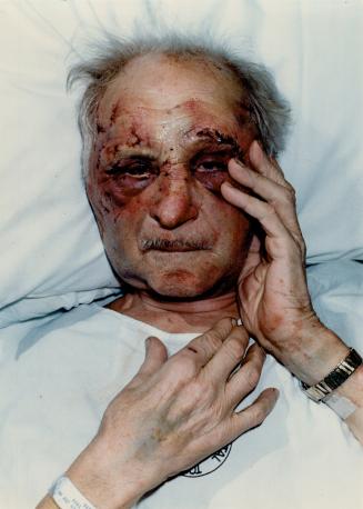 Toomas Turk, his face laced with 50 stitches, recovers in hospital after a savage attack by a burglar in his east-end home
