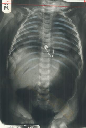 Fatal pin: An x-ray taken during an autopsy showed pin lodged in 8-month-old Andrew Knighton's esophagus, piercing his heart.